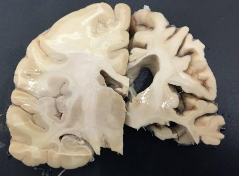 cerebro humano